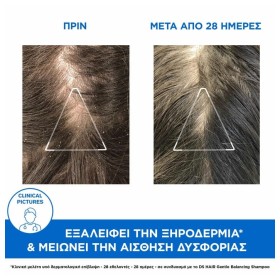 Preview 2 of Uriage Ds Hair Anti Dandruff Treatment Shampoo 200ml (Σαμπουάν για Μέτρια Πιτυρίδα Ξηρή ή Λιπαρή)